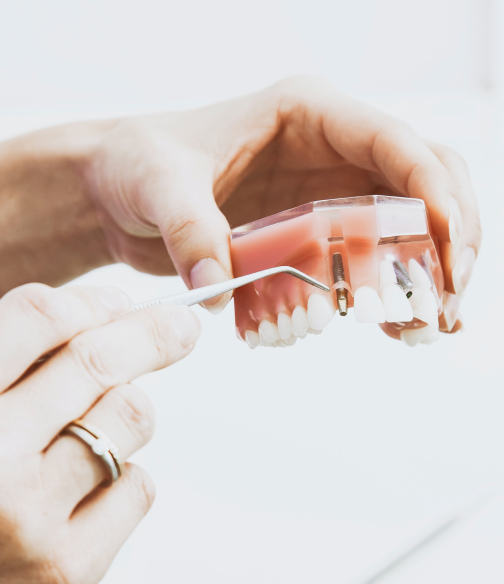 implantes dentales Sevilla